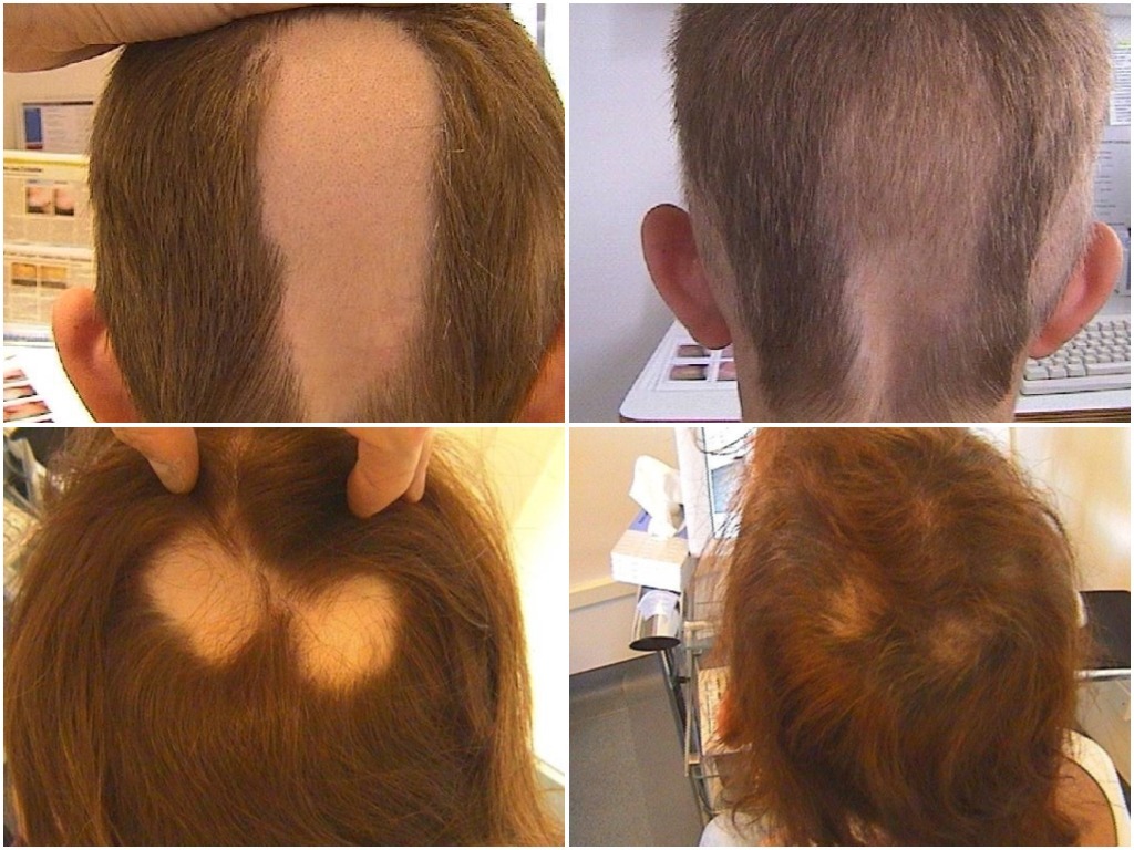 Jak se zbavit alopecie?