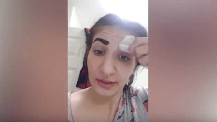 Dívka přišla o levé obočí Dívka přišla o levé obočí