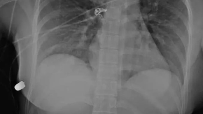 Prsní implantáty 1 Prsní implantáty 1
