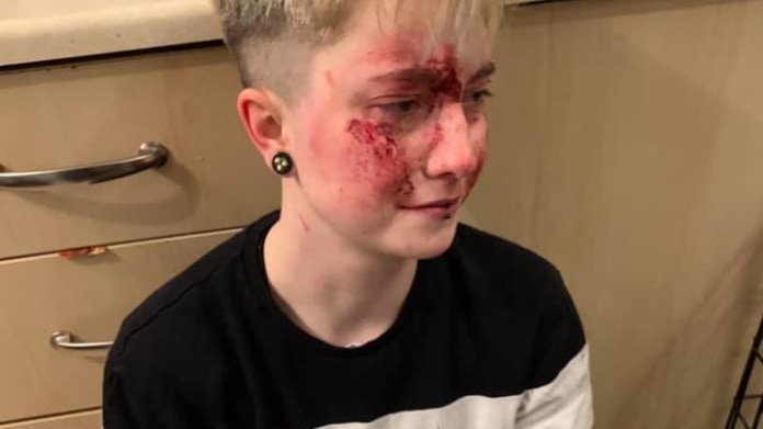 Dívka byla napadená kvůli homofobii 3 Dívka byla napadená kvůli homofobii 3