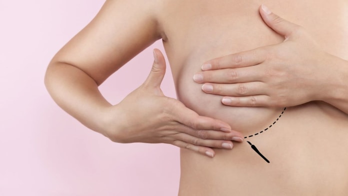 Plastika prsou - změnily se hlavně implantáty Plastika prsou - změnily se hlavně implantáty
