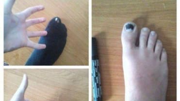 Stačí lihovka a díra na ponožce je pryč Stačí lihovka a díra na ponožce je pryč