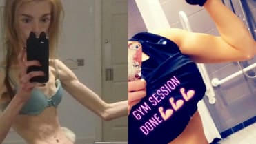 Dívka porazila anorexii čokoládou 4 Dívka porazila anorexii čokoládou 4