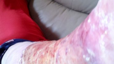 Ženě museli amputovat nohu poté, co se řízla při holení 5 Ženě museli amputovat nohu poté, co se řízla při holení 5