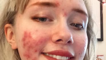 Hailey Wait - Dívka s akné 1 Hailey Wait - Dívka s akné 1