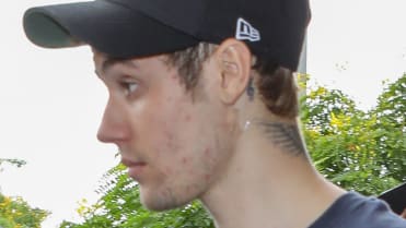 Justin Bieber bojuje s lymskou boreliózou. Justin Bieber bojuje s lymskou boreliózou.