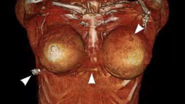 Prsní implantáty 2 Prsní implantáty 2