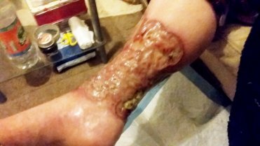 Ženě museli amputovat nohu poté, co se řízla při holení 3 Ženě museli amputovat nohu poté, co se řízla při holení 3