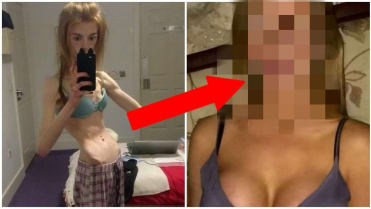 Dívka porazila anorexii čokoládou 11 Dívka porazila anorexii čokoládou 11