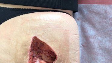 Žena chtěla zadek jako Kim Kardashian, teď žaluje kliniku 1 Žena chtěla zadek jako Kim Kardashian, teď žaluje kliniku 1
