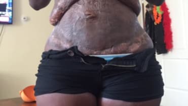 Zdeformované břicho po liposukci Zdeformované břicho po liposukci