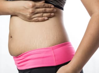 Povolená kůže, strie, pigmentové skvrny, padající vlasy... Jak si vylepšit tělo po porodu? Povolená kůže, strie, pigmentové skvrny, padající vlasy... Jak si vylepšit tělo po porodu?