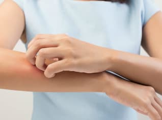 Jak se zbavit svědění po komářím štípnutí Jak se zbavit svědění po komářím štípnutí