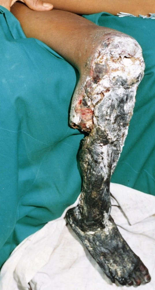 Nekróza končetiny určené k amputaci po uštknutí druhem Bothrops asper Nekróza končetiny určené k amputaci po uštknutí druhem Bothrops asper