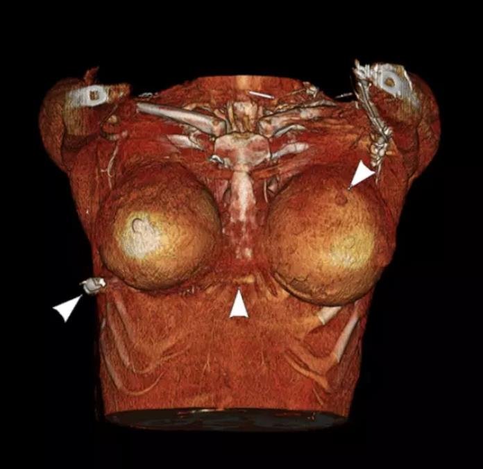 Prsní implantáty 2 Prsní implantáty 2
