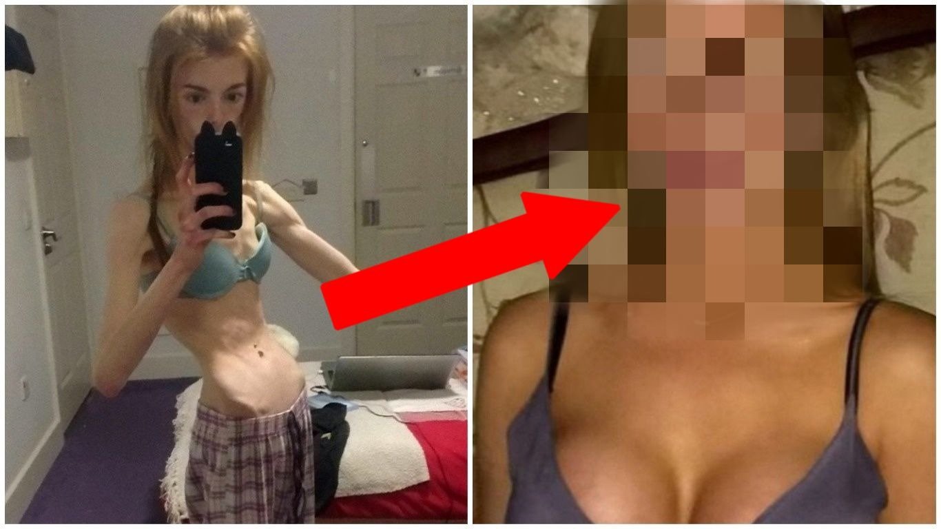 Dívka porazila anorexii čokoládou 11 Dívka porazila anorexii čokoládou 11