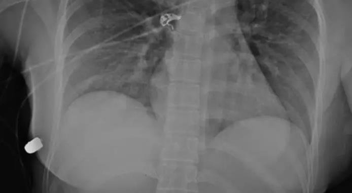 Prsní implantáty 1 Prsní implantáty 1