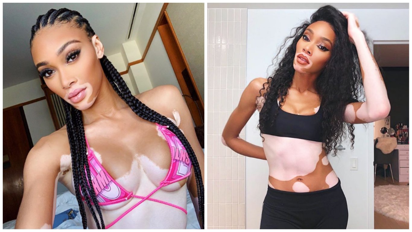 Winnie Harlow (Kanada) Winnie Harlow (Kanada)