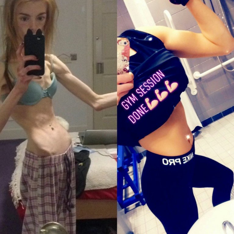 Dívka porazila anorexii čokoládou 4 Dívka porazila anorexii čokoládou 4