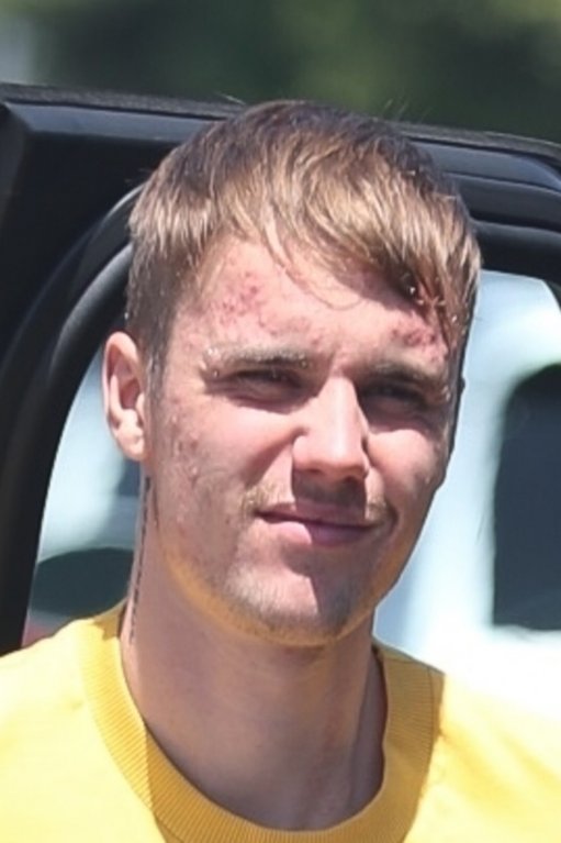 Justin Bieber má navíc také mononukleózu. Justin Bieber má navíc také mononukleózu.