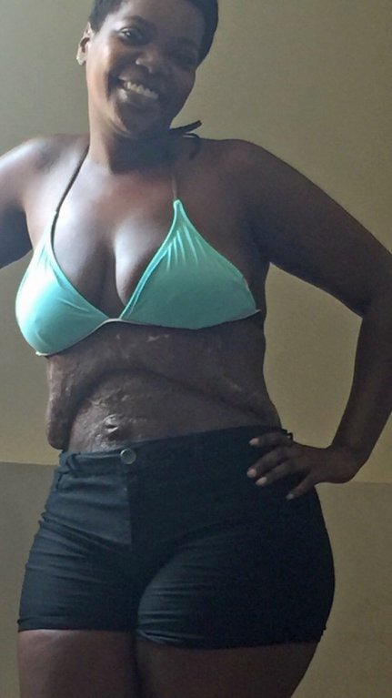 Zdeformované břicho po liposukci Zdeformované břicho po liposukci