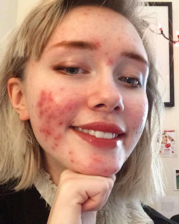 Hailey Wait - Dívka s akné 1 Hailey Wait - Dívka s akné 1
