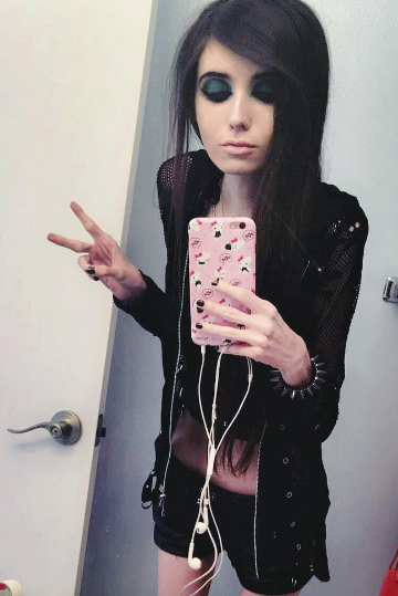 Vážně trpí anorexií. Vážně trpí anorexií.