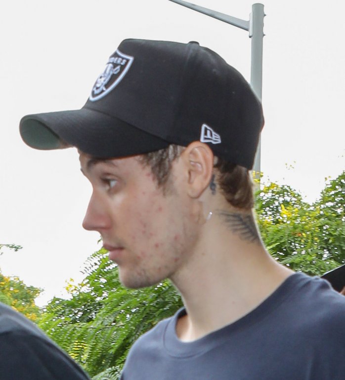 Justin Bieber bojuje s lymskou boreliózou. Justin Bieber bojuje s lymskou boreliózou.