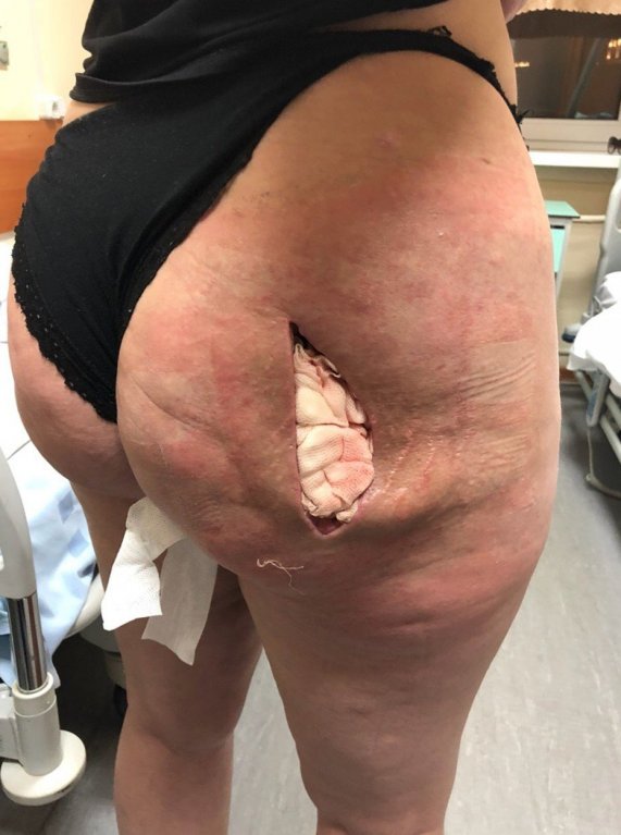 Žena chtěla zadek jako Kim Kardashian, teď žaluje kliniku 2 Žena chtěla zadek jako Kim Kardashian, teď žaluje kliniku 2