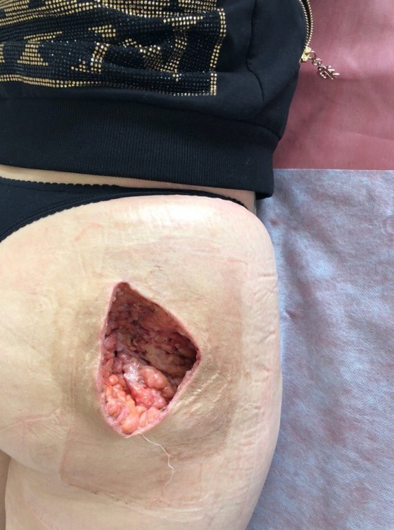Žena chtěla zadek jako Kim Kardashian, teď žaluje kliniku 1 Žena chtěla zadek jako Kim Kardashian, teď žaluje kliniku 1